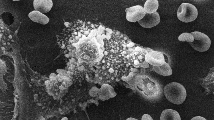 Immagine al microscopio di macrofagi che iniziano a fondersi e ad iniettare tossine nel la cellula tumorale
